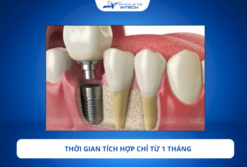 Trụ Implant Straumann có thời gian tích hợp trụ chỉ mất khoảng 1 - 2 tháng