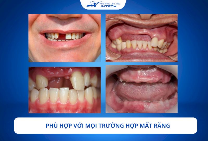 Trụ Implant Straumann được thiết kế đa dạng về kích thước và hình dáng, phù hợp với mọi trường hợp mất răng