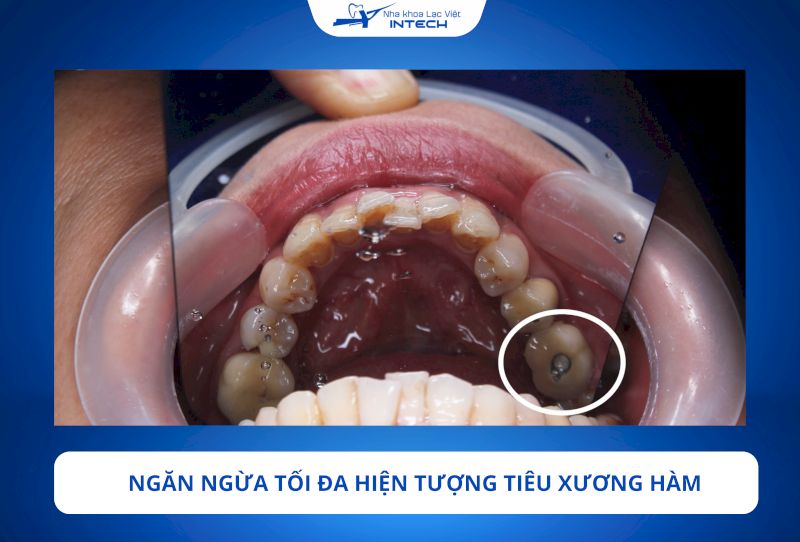 Trụ Implant Straumann được tích hợp tốt và vững chắc với xương hàm nhờ công nghệ xử lý bề mặt SLA và SLActive, giúp kích thích sự sinh xương hiệu quả