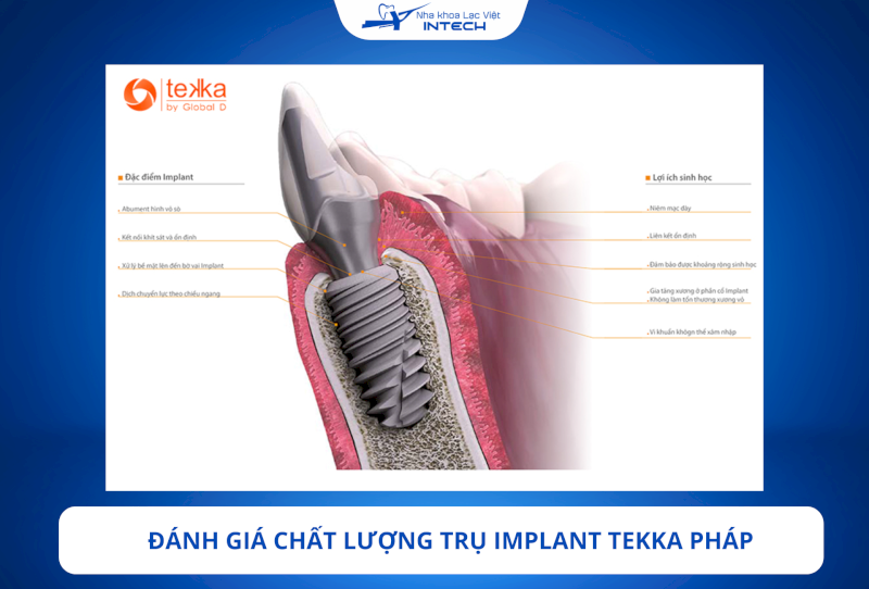 Trụ Implant Tekka Pháp được nhiều chuyên gia nha khoa tại châu Âu và Việt Nam đánh giá cao