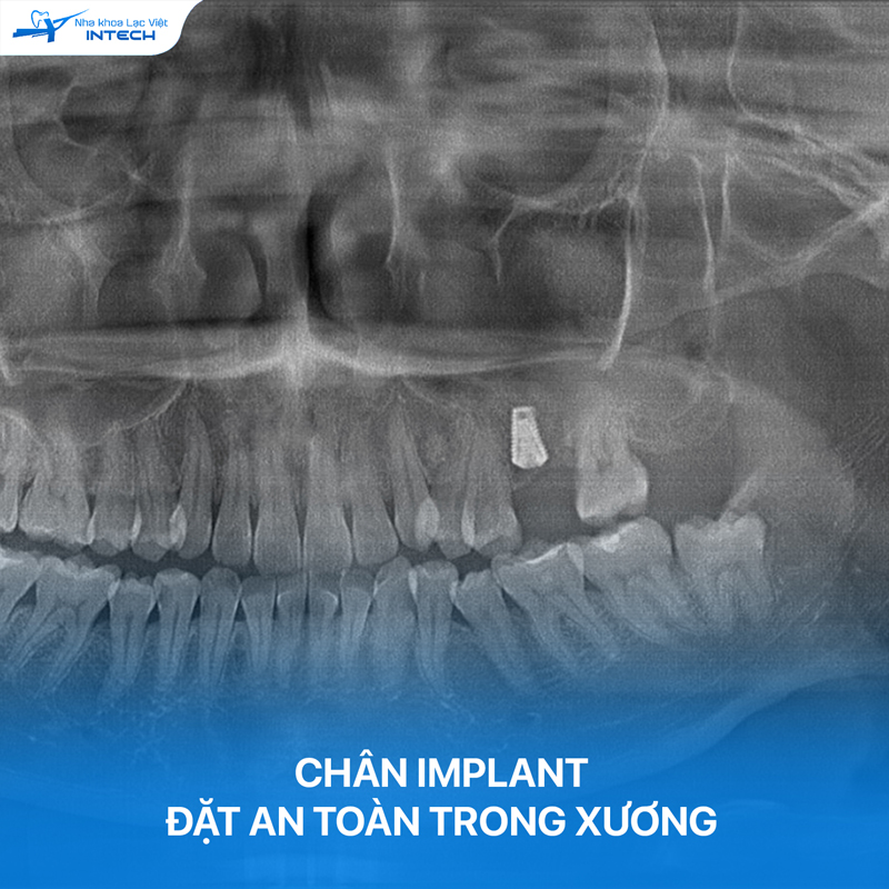Implant thường được làm từ các vật liệu không kim loại, không ảnh hưởng tới tia X nên cô chú/anh chị hoàn toàn có thể chụp X-quang sau khi trồng Implant