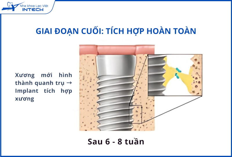 Các mô xương mới bám chắc quanh trụ, tạo thành một khối thống nhất giữa Implant với xương hàm