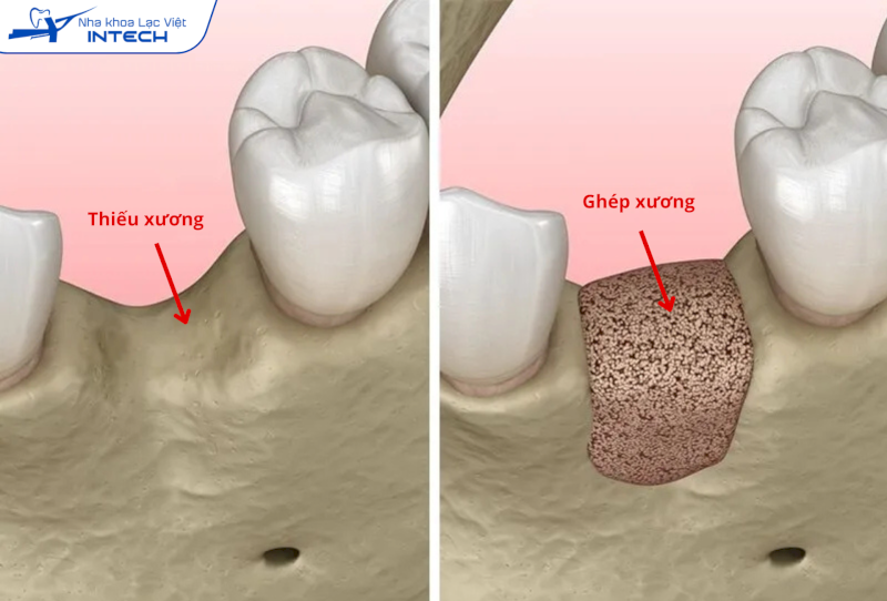 Ghép xương là thủ thuật được chỉ định cho các đối tượng bị thiếu hụt thể tích xương hàm, không đủ điều kiện cắm Implant