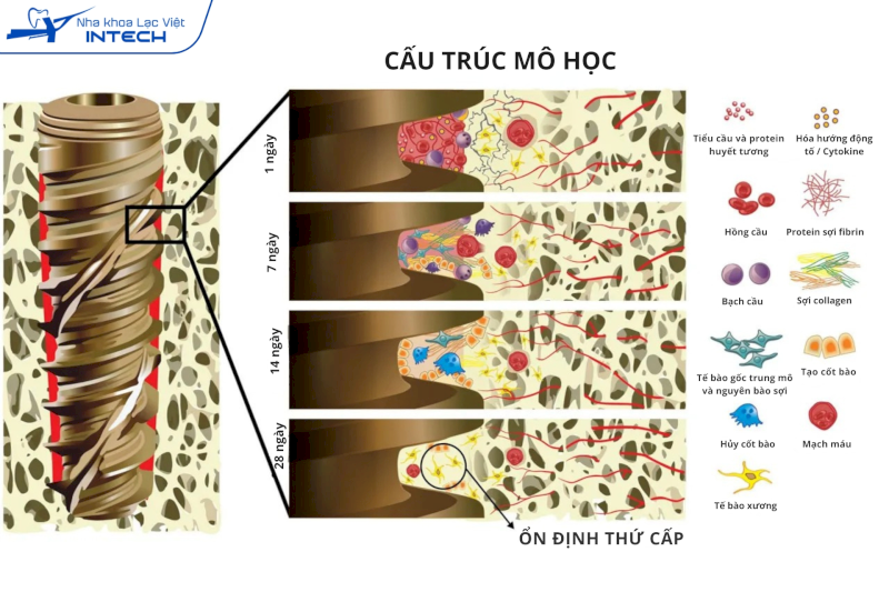 4 dấu hiệu cảnh báo Implant tích hợp xương kém cần lưu ý!