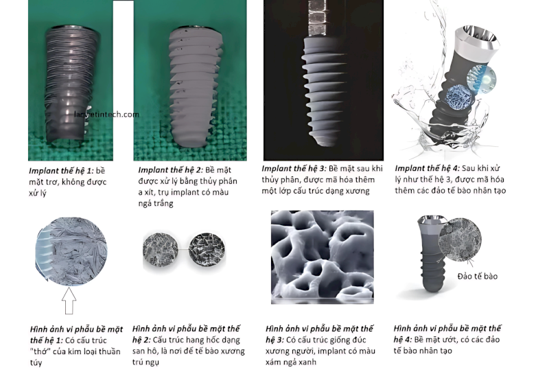 Tốc độ tích hợp xương tùy thuộc vào thiết kế của trụ Implant và công nghệ xử lý bề mặt