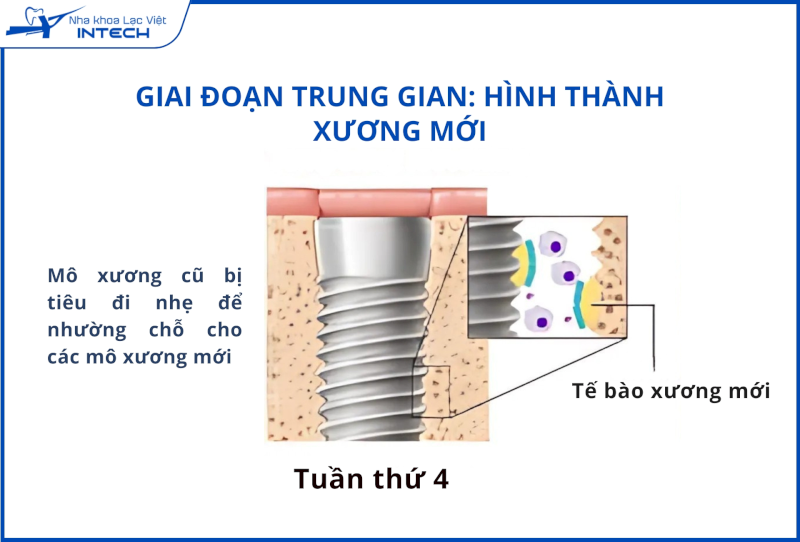 Trong giai đoạn 2, Implant có thể bị lỏng nhẹ do quá trình 