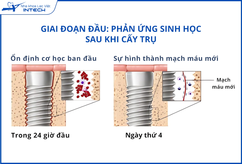 Trong giai đoạn đầu sau cắm Implant, các tế bào máu bao phủ quanh trụ, hình thành các cục máu đông