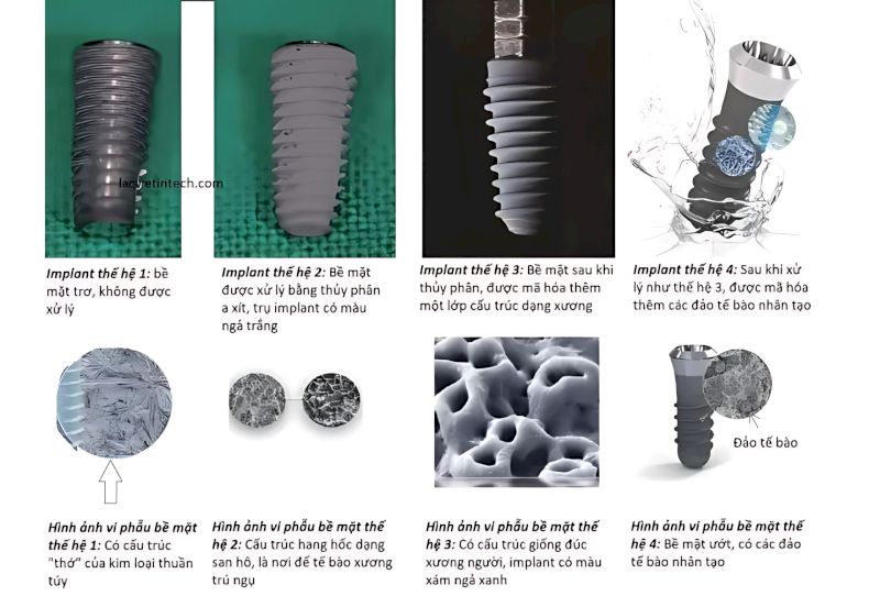 Các công nghệ xử lý bề mặt tiên tiến giúp tăng khả năng tích hợp xương hàm cho Implant Titanium