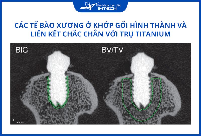 Các mô xương mới tập trung và bám dính quanh trụ Titanium, tạo thành liên kết sinh học an toàn và vững chắc