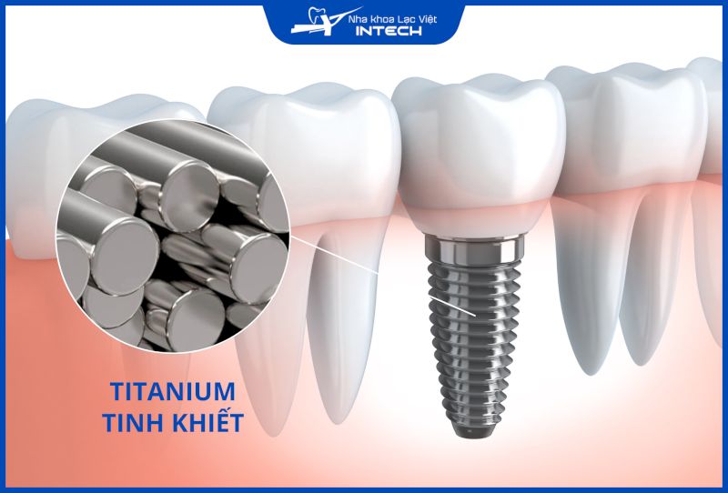 Implant Titanium được ứng dụng nhiều trong cấy ghép nha khoa vì độ bền và độ tương thích sinh học cao