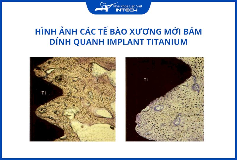 Kết quả thực nghiệm của Giáo sư Branemark cho thấy Titanium tích hợp tốt với xương hàm và tồn tại hơn 20 năm