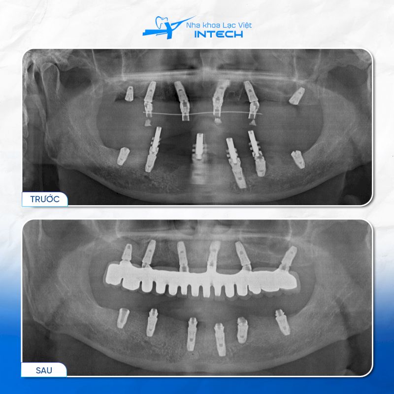 Người đã cắm Implant Titanium vẫn có thể chụp X-quang hoặc MRI do Titanium không có từ tính
