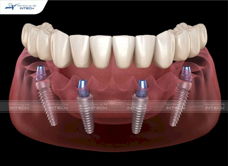 Thiết kế nhiều vòng ren xoắn chuyển hướng của trụ Implant vừa giúp chống xoay vừa giúp thúc đẩy tích hợp xương
