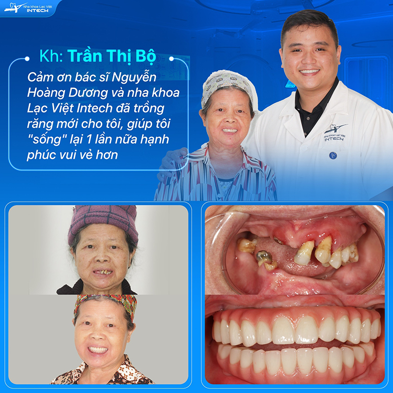 Hàm tạm được lắp trong thời gian chờ trụ Implant tích hợp với xương