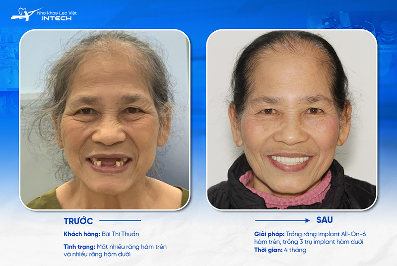 Nhờ các phương pháp hiện đại, bác sĩ chỉ cần cấy từ 4 đến 6 trụ Implant để làm chân đỡ, giúp tiết kiệm chi phí đáng kể