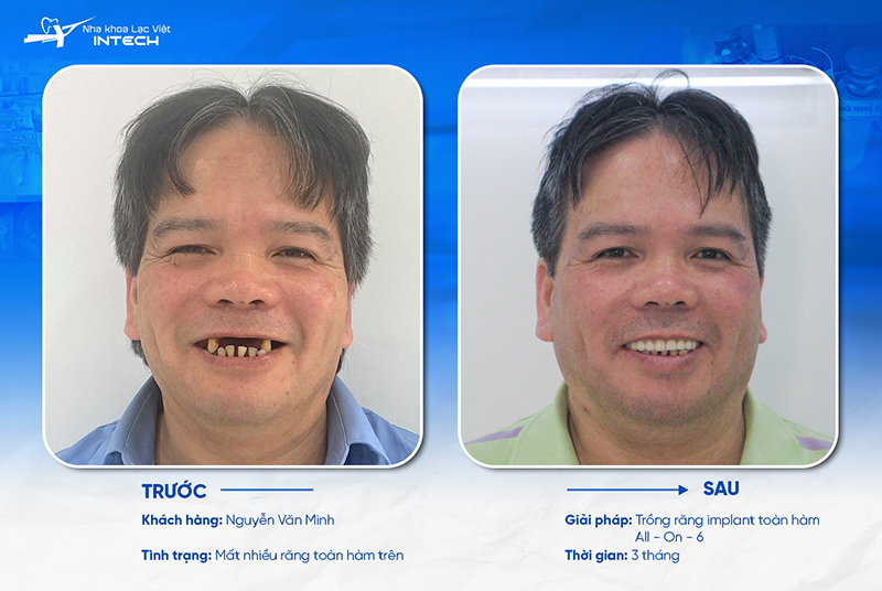 Trồng răng Implant toàn hàm mang lại nhiều lợi ích vượt trội và dài lâu cho cô chú/anh chị bị mất răng