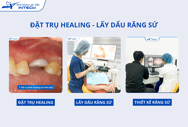 Quá trình đặt trụ Healing và thiết kế răng sứ có thể mất khoảng 5 đến 7 ngày