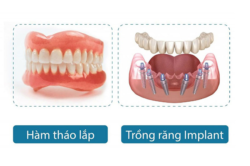 So với hàm giả tháo lắp, trồng Implant toàn hàm mang đến nhiều lợi ích ưu việt hơn