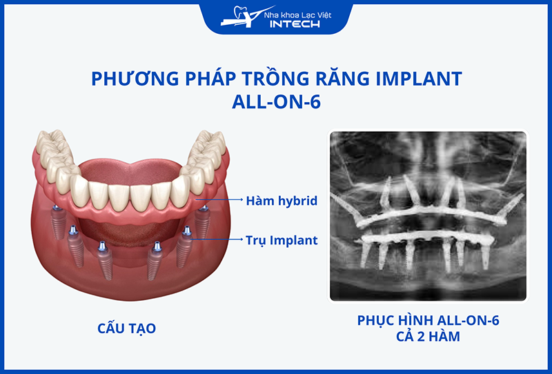 Trồng Implant toàn hàm All-On-6 sử dụng 6 trụ Implant làm chân đỡ cho hàm giả bên trên
