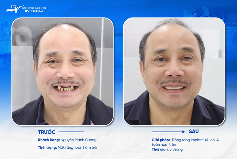 Trồng Implant toàn hàm giúp khôi phục thẩm mỹ lâu dài cho người bị mất răng lâu năm