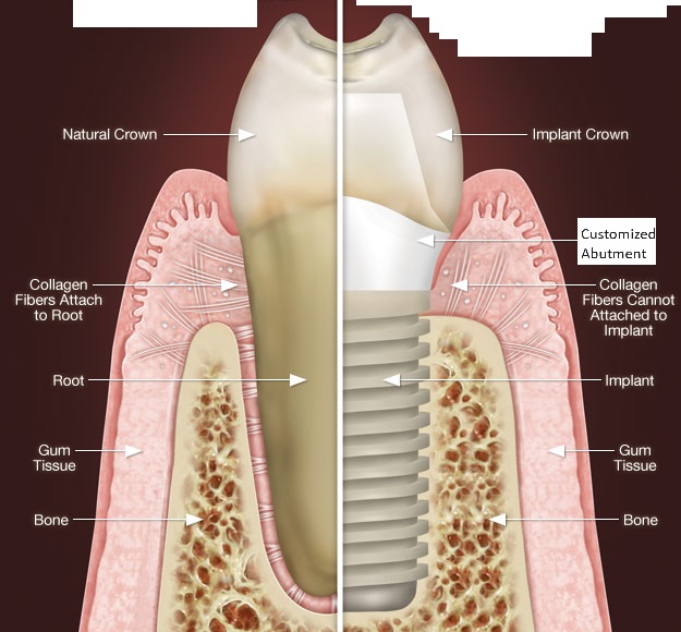 trồng răng implant DCT