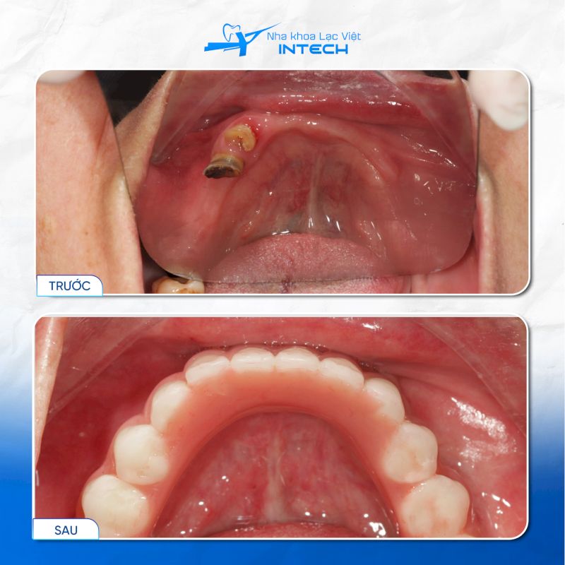 Implant Yes Biotech có giá thành rẻ nhưng mang lại chất lượng ổn định