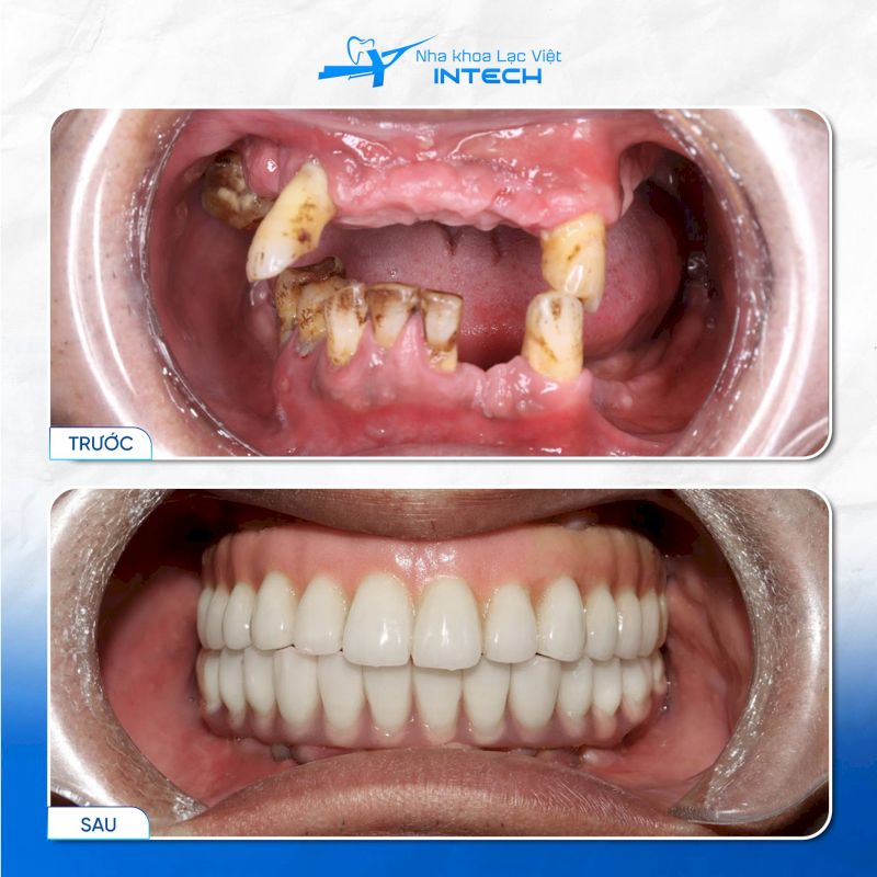 Trụ có tỉ lệ trùng khớp cao với răng thật và phục hồi hoàn hảo chức năng ăn nhai 