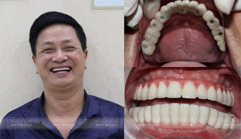 Kết quả chú Chu Văn Bảy sau khi lắp răng hoàn thiện