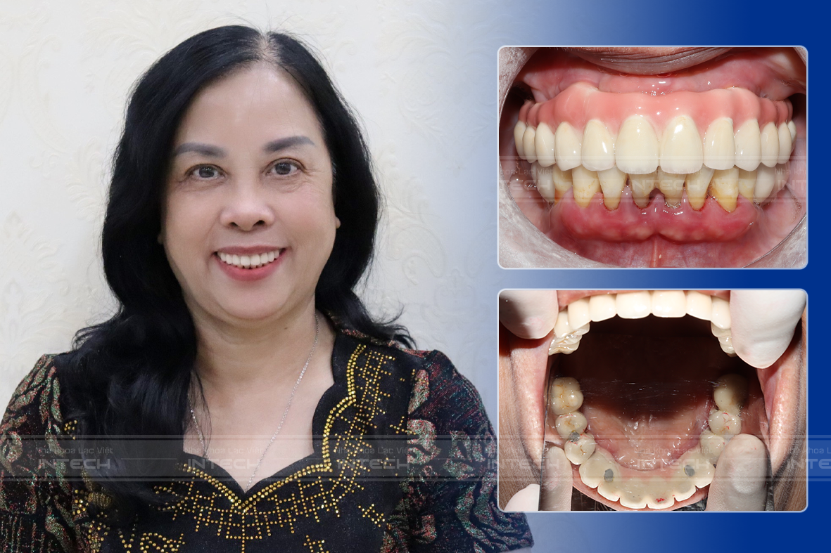 Kết quả sau khi lắp hàm cố định của cô Cầm