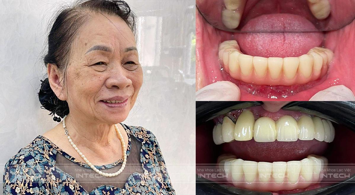 Kết quả sau khi lắp hàm tạm của bác Minh Phương