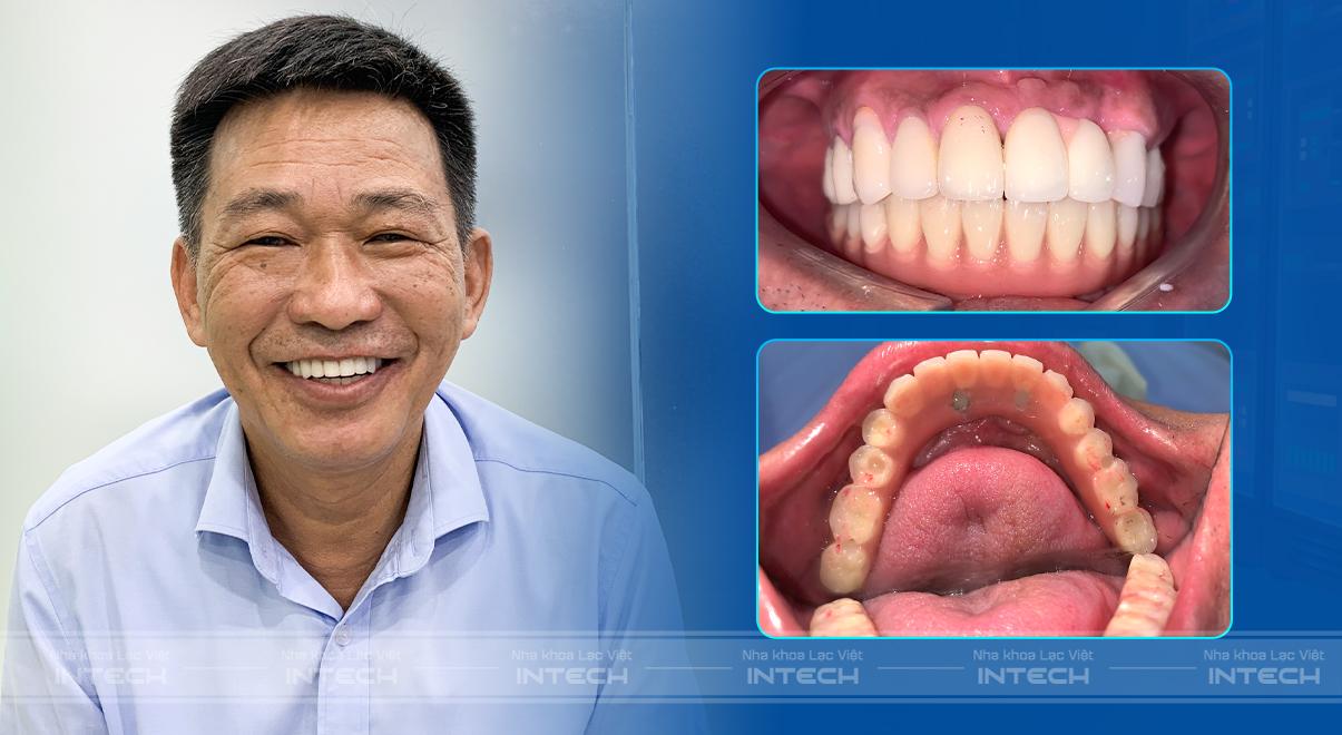 Kết quả sau lắp răng cố định của chú Nghiệp
