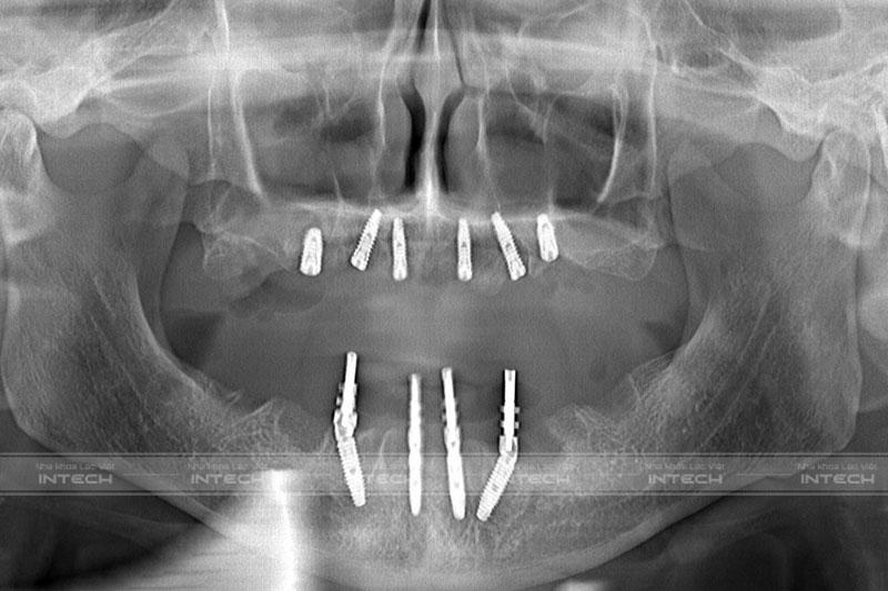 Kết quả sau khi cấy ghép Implant của chú Nguyễn Đức Tính