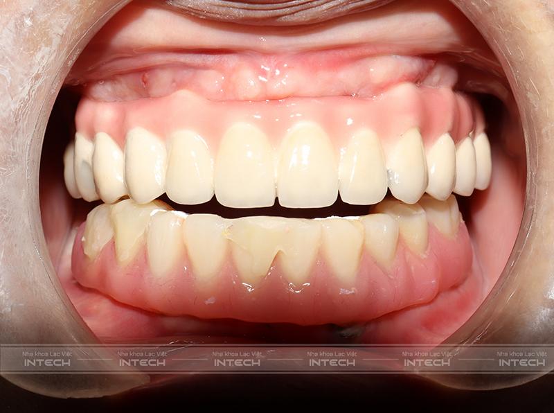 Kết quả sau khi lắp hàm tạm của cô Nguyễn Thị Thủy