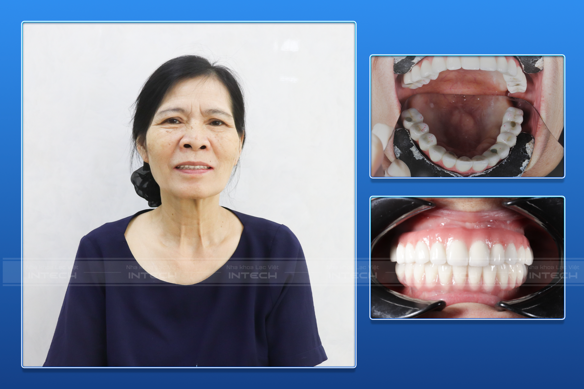 Kết quả sau khi trồng răng All On 4 toàn hai hàm của cô Hải