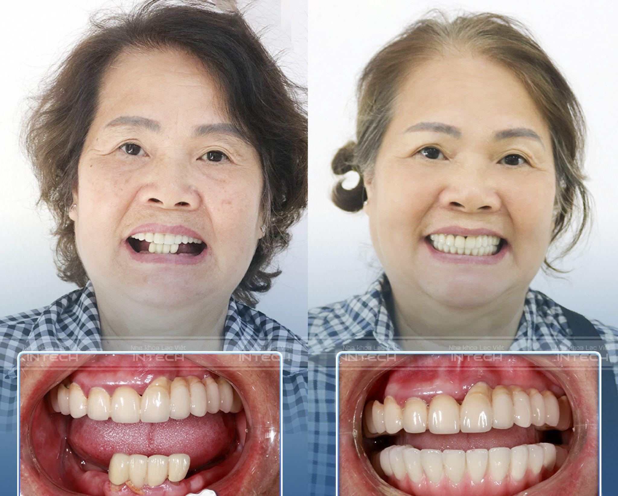 Khách hàng cấy ghép trụ nước ái sinh học