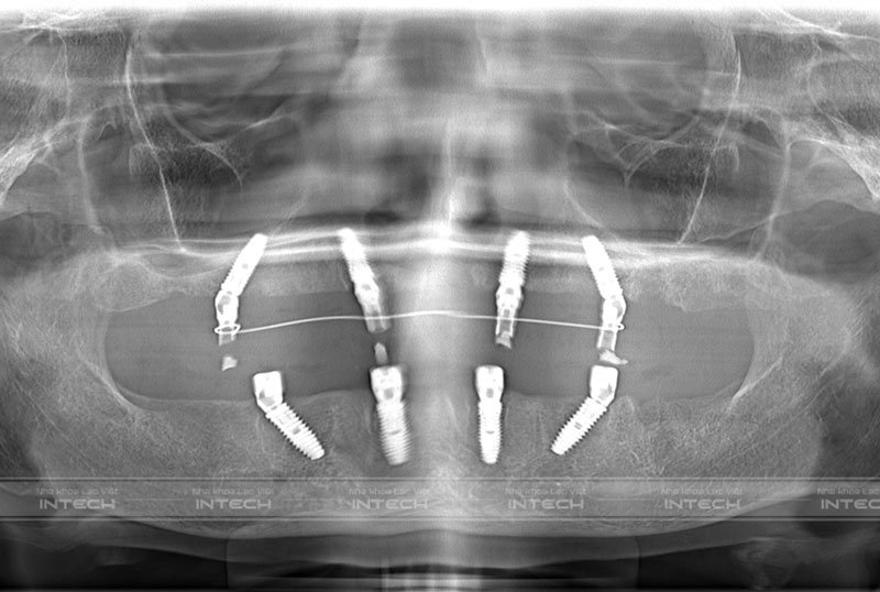Hình ảnh phim chụp CT của cô Tô Thị Hải