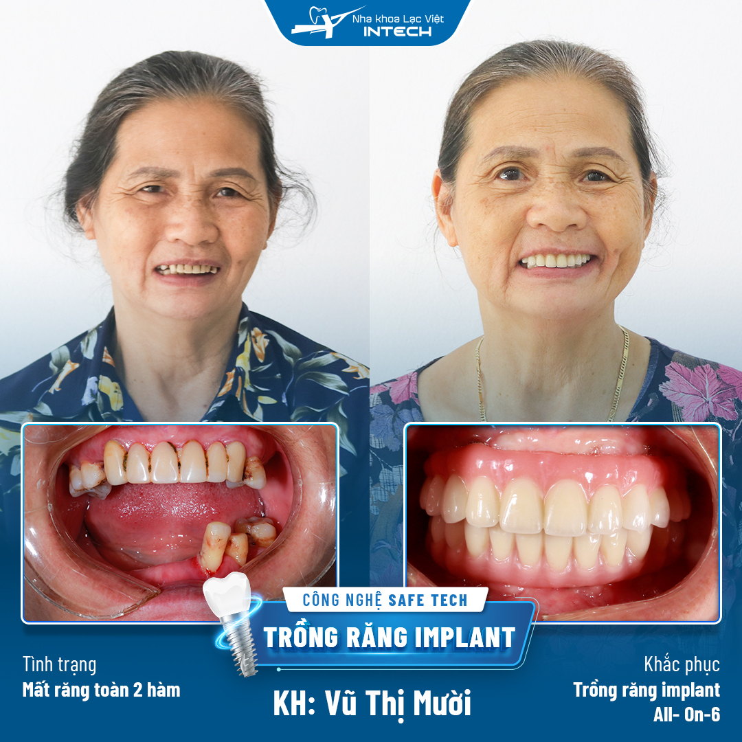 Khách hàng Vũ Thị Mười sau trồng răng Implant All-on-6 toàn 2 hàm