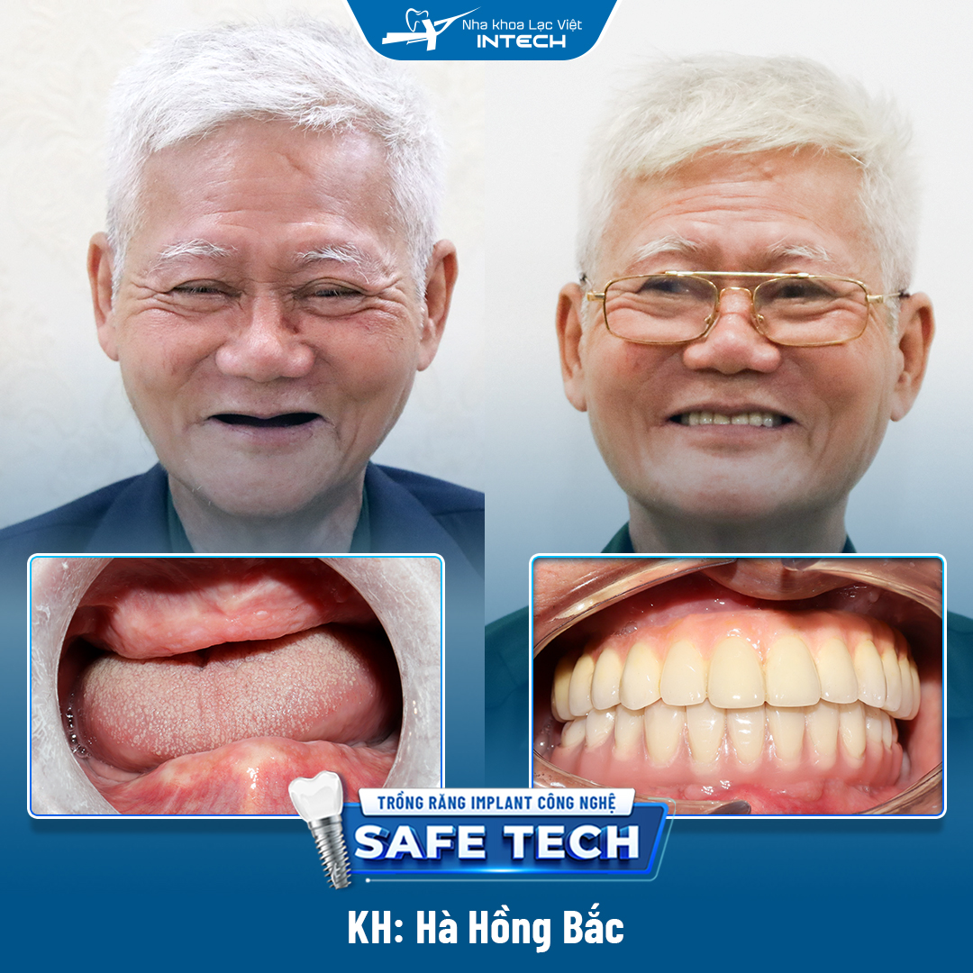 Bệnh nhân bị tiểu đường 10 cấy ghép implant thành công bằng công nghệ Safe - tech
