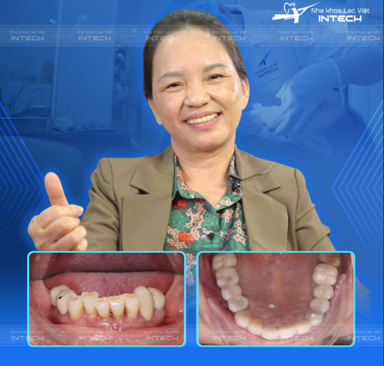 Khách hàng với nụ cười tự tin sau khi trồng răng implant