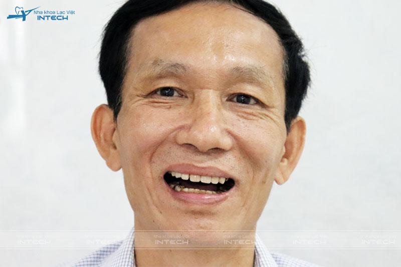 Hỏng cả hàm răng vì làm cầu sứ sai cách, chú Phương khổ sở vì ăn nhai khó khăn