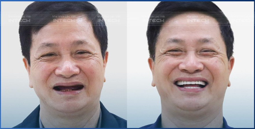 công nghệ cấy ghép implant giúp lành thương nhanh