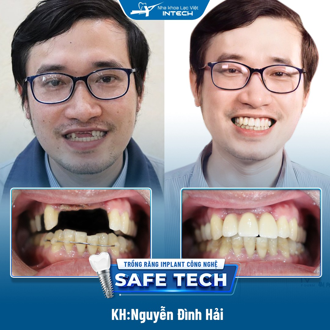 Khách hàng Nguyễn Đình Hải trồng răng cửa hàm trên với công nghệ Safe Tech