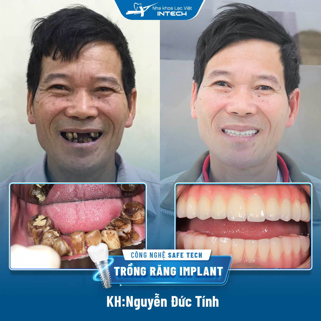 Chú Nguyễn Đức Tính cấy ghép Implant All On 6 hàm trên và All on 4 hàm dưới