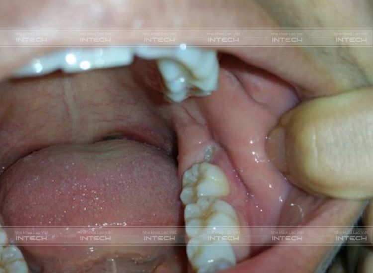 Không dùng tay sờ, nắn hay chạm vào vị trí mọc răng khôn