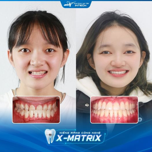 khớp cắn loại 3