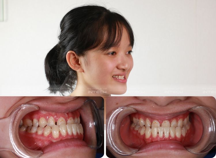 khớp cắn ngược loại 3