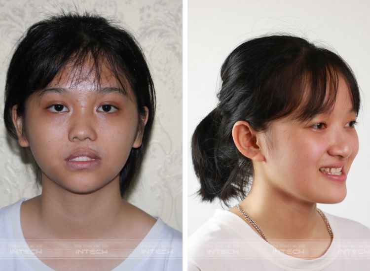 khớp cắn ngược nặng