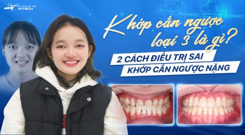 Khớp cắn ngược loại 3 là gì? 2 Cách điều trị sai khớp cắn ngược nặng