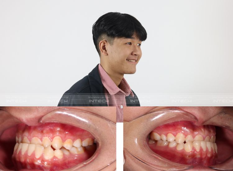 chỉnh khớp cắn ngược cho bé