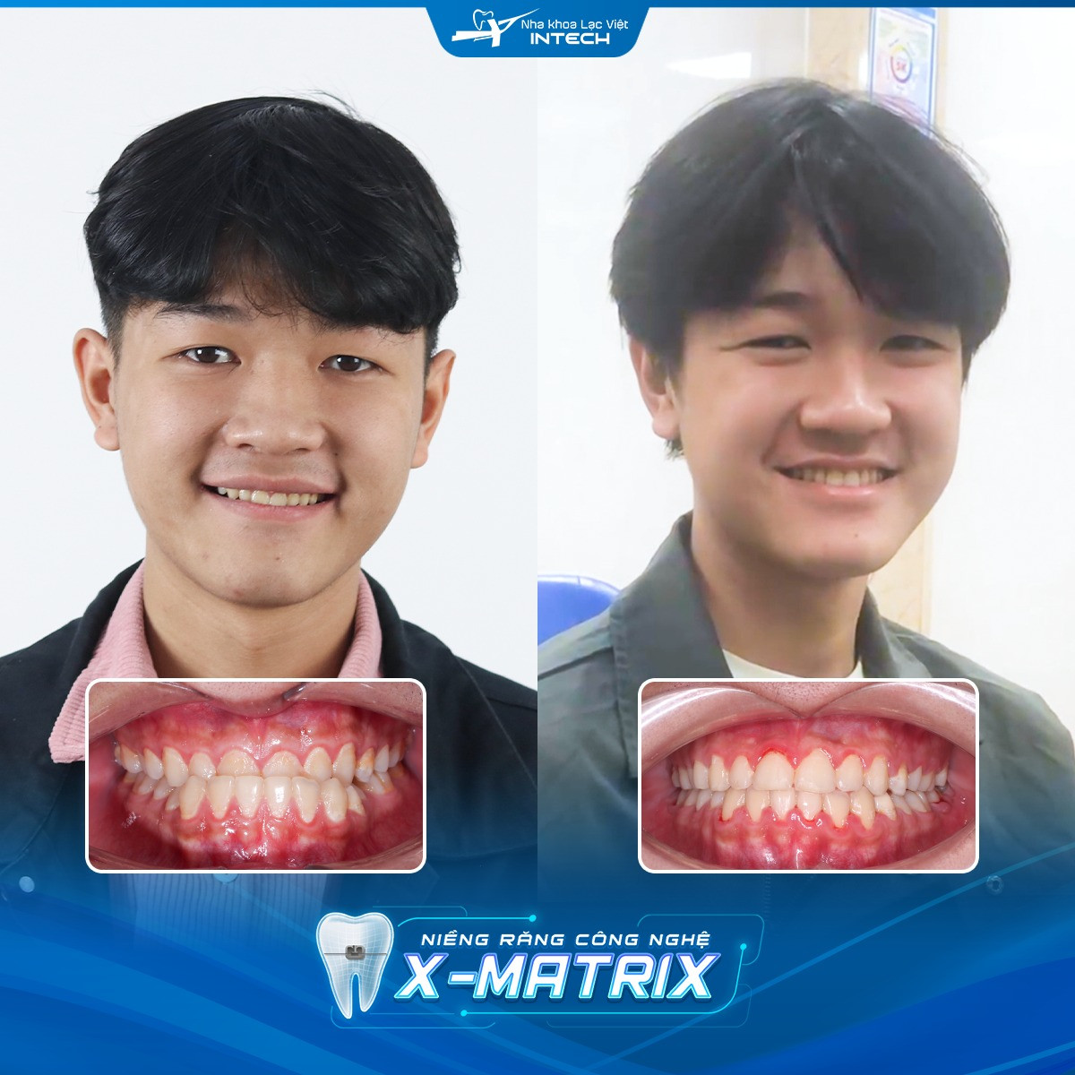 điều trị khớp cắn ngược ở trẻ em
